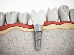 implant_img002